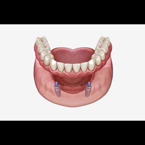 Camila prothetischemondzorg image 4